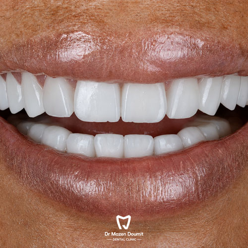 img-213-Dr-Mazen-Doumit-dentist-lebanonsmile 01