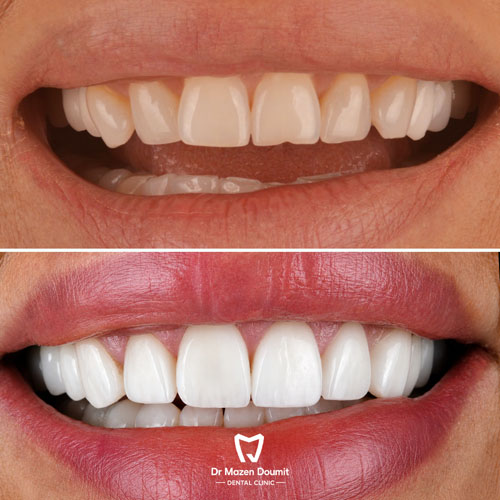 img-214-Dr-Mazen-Doumit-dentist-lebanonBefore After 01