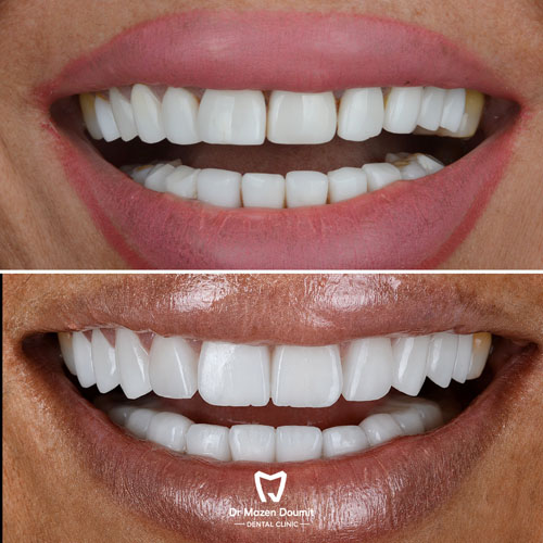 img-214-Dr-Mazen-Doumit-dentist-lebanonBefore After 02