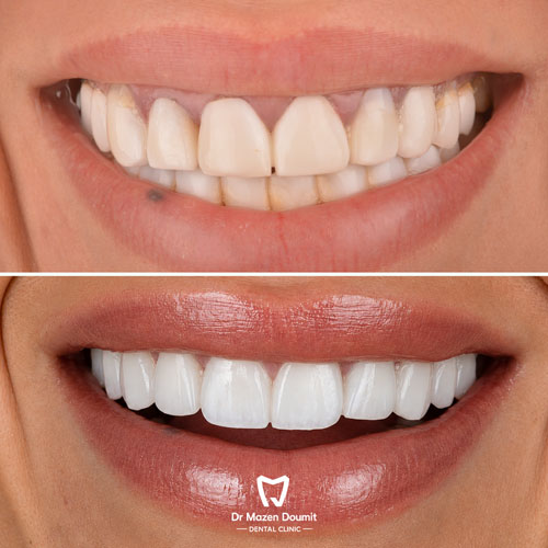 img-214-Dr-Mazen-Doumit-dentist-lebanonBefore After 03