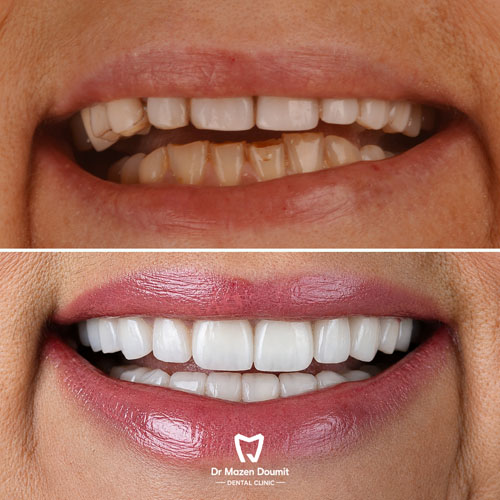 img-214-Dr-Mazen-Doumit-dentist-lebanonBefore After 04