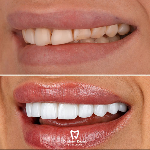 img-214-Dr-Mazen-Doumit-dentist-lebanonBefore After 05